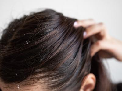 跟損傷性頭皮屑說再見