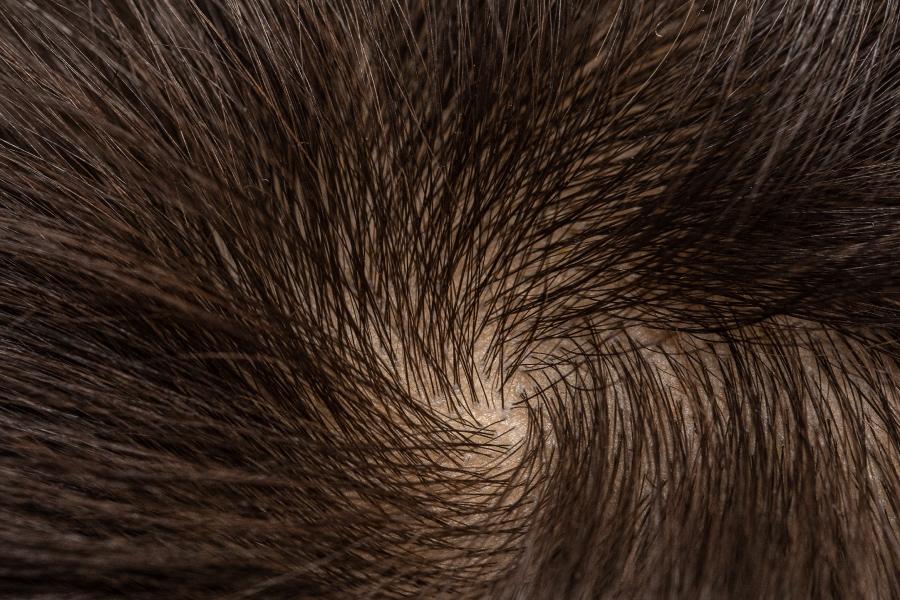 當免疫力失衡「誤攻自己」自體免疫與落髮的關係