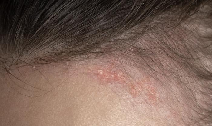 頭皮也有酒糟性皮膚炎?!教您如何保養酒糟肌