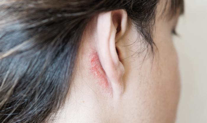 別讓頭皮牛皮癬影響你的生活！改善關鍵就在日常保養