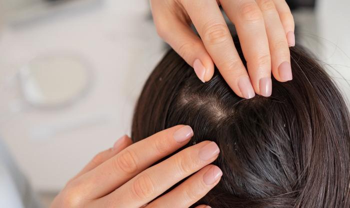 頭皮上也有蟲？！帶妳認識頭皮蠕形蟎蟲？