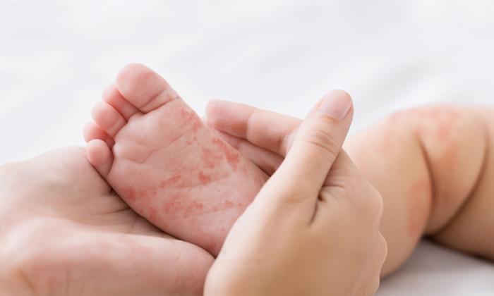 新生兒「奶痂、紅疹」全攻略:正確保養 3 步驟,告別新手爸媽焦慮!