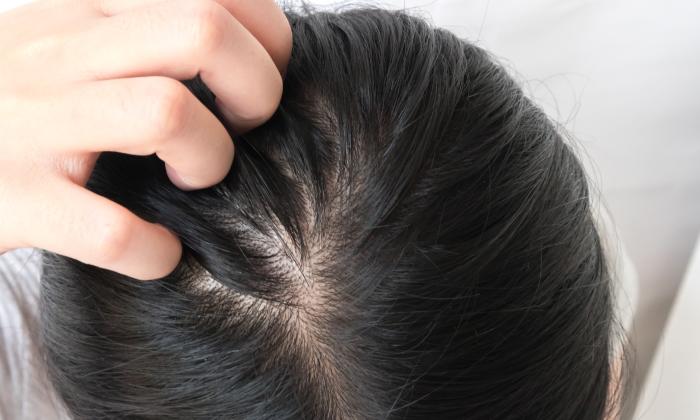 臉皮要呵護,頭皮脂漏性問題也需小心照顧!