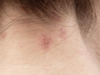 如何照顧脂漏性&異位性頭皮