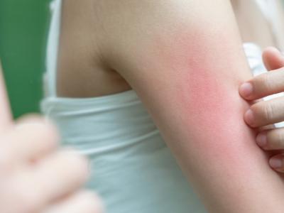 什麼是脂漏性皮膚炎?該怎麼治療與改善?